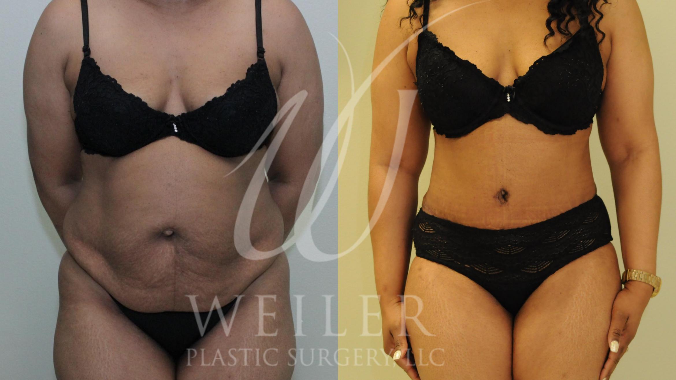 Tummy Tuck Before & After Photo | Baton Rouge, Louisiana | Weiler Plastic Surgery