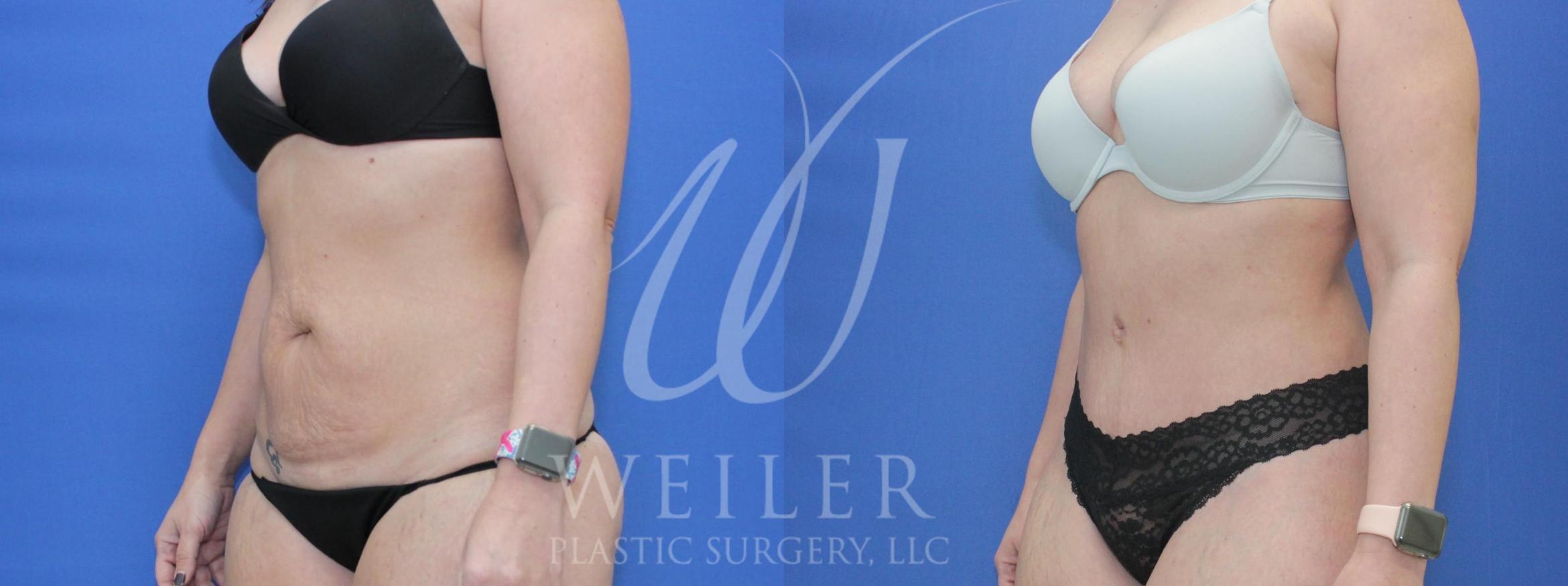 Tummy Tuck Before & After Photo | Baton Rouge, Louisiana | Weiler Plastic Surgery