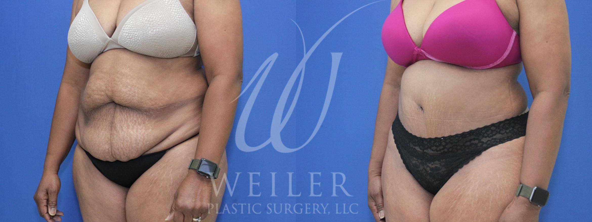 Tummy Tuck Before & After Photo | Baton Rouge, Louisiana | Weiler Plastic Surgery