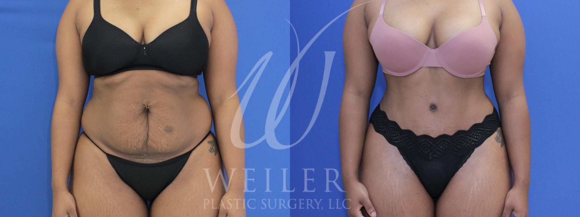 Before & After Tummy Tuck Case 620 Front View in Baton Rouge, Louisiana