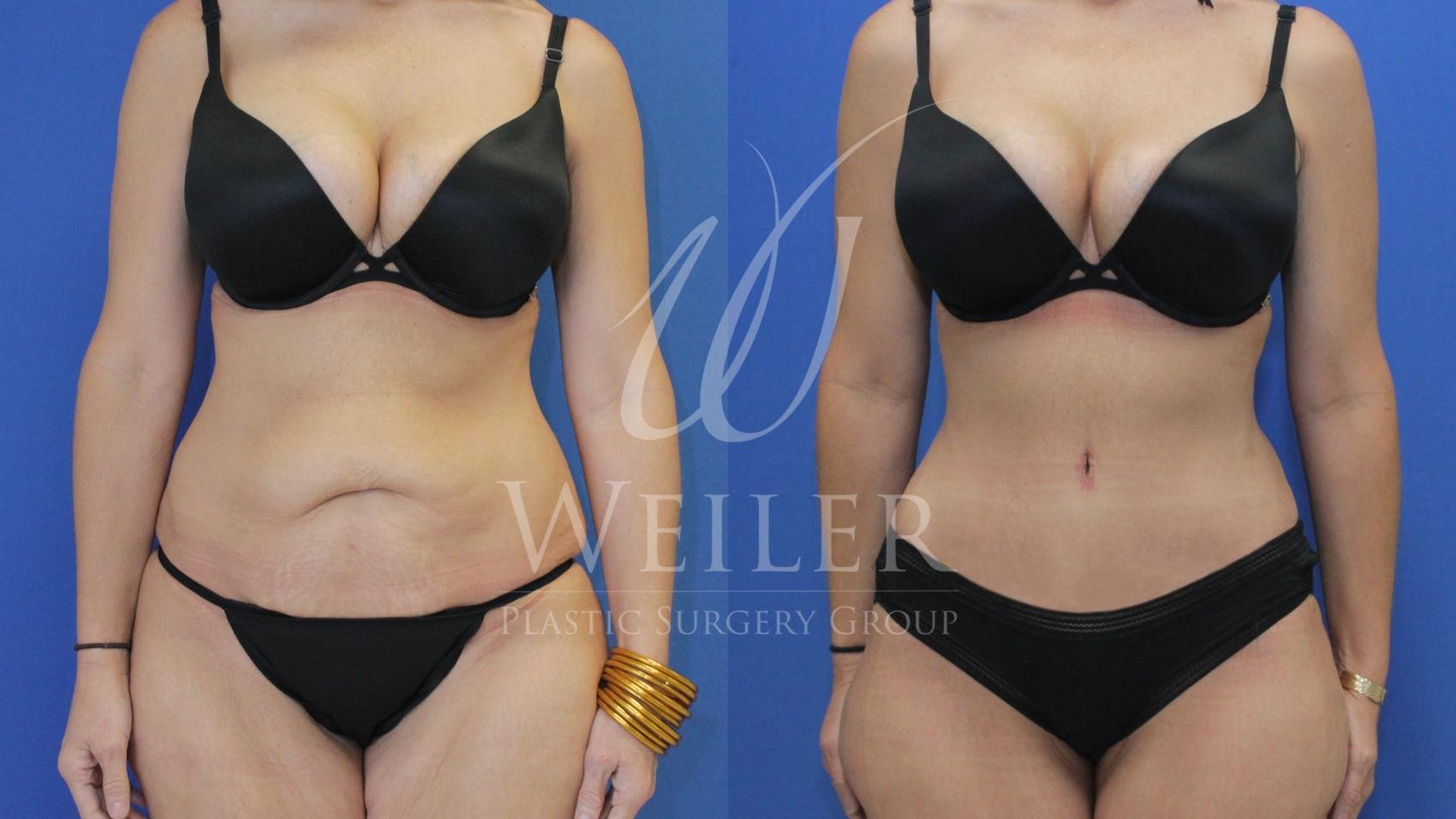Before & After Tummy Tuck Case 627 Front View in Baton Rouge, New Orleans, & Lafayette, Louisiana