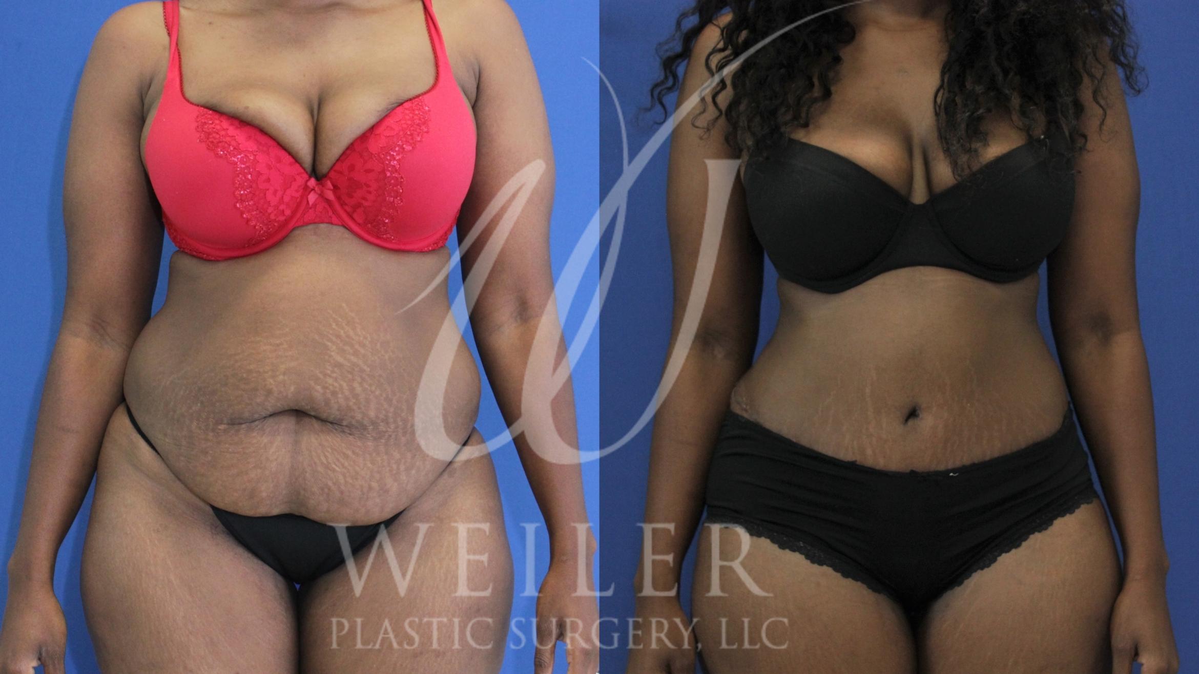 Tummy Tuck Before & After Photo | Baton Rouge, Louisiana | Weiler Plastic Surgery