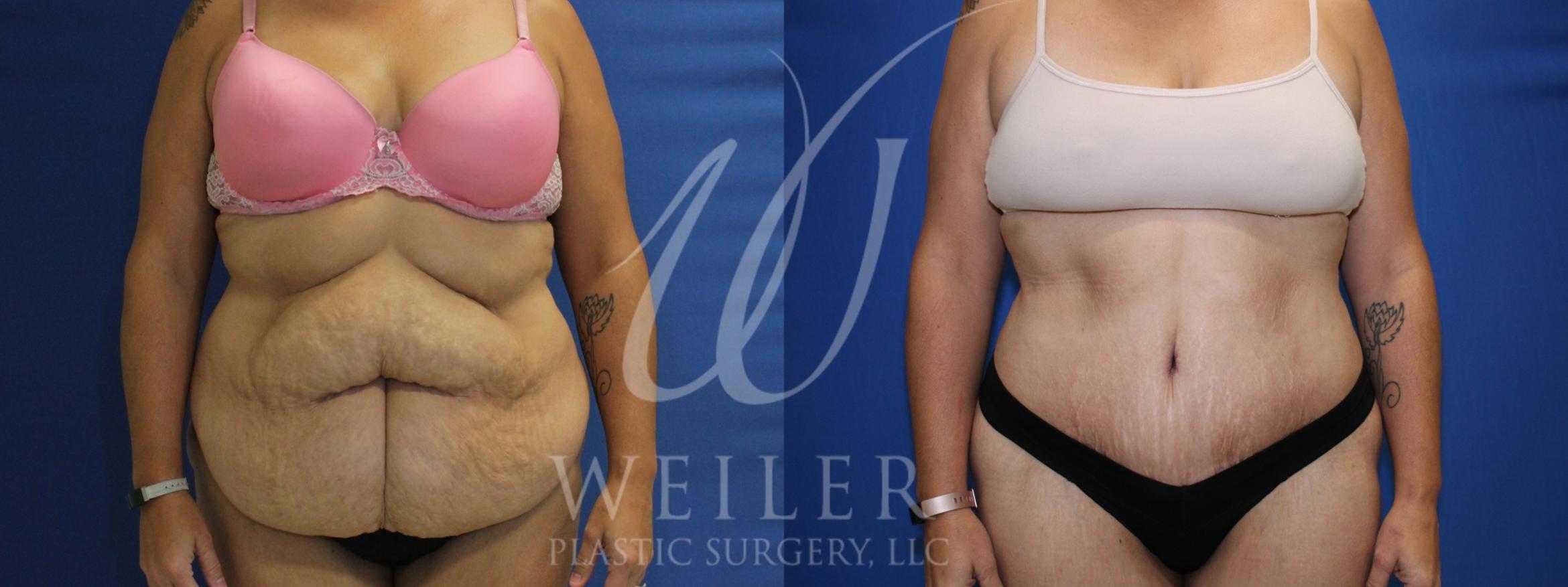 Tummy Tuck Before & After Photo | Baton Rouge, Louisiana | Weiler Plastic Surgery