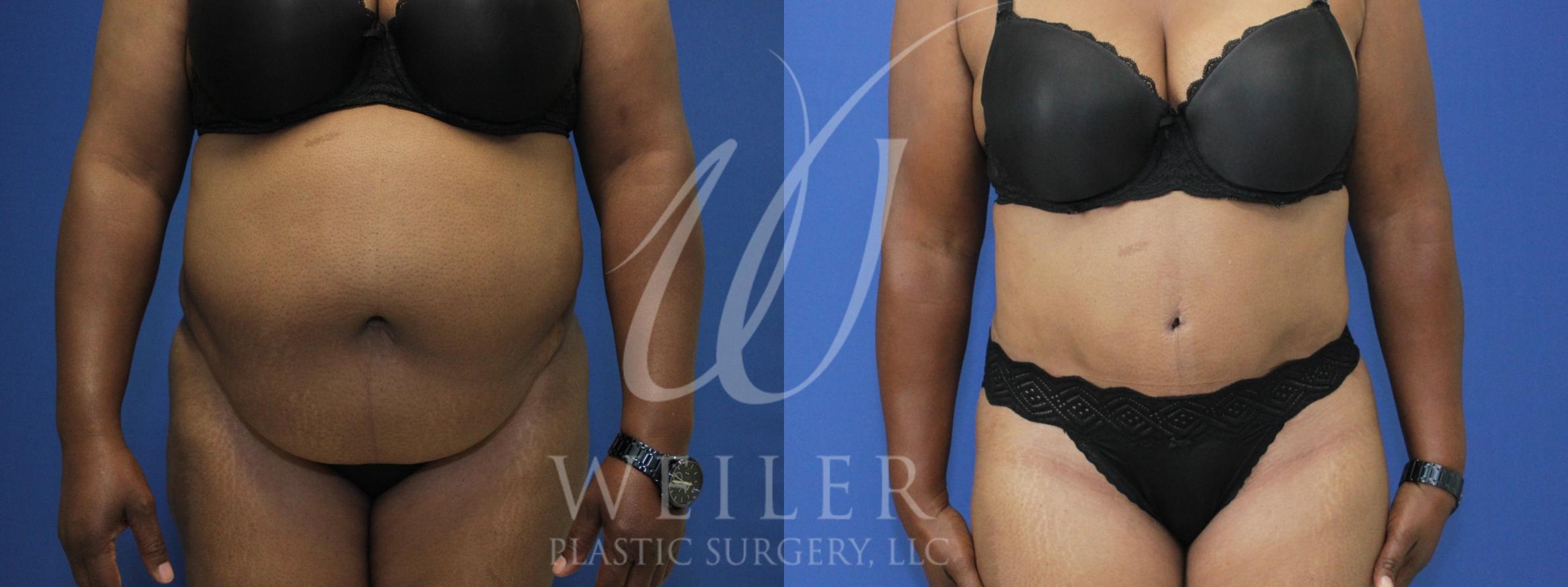 Tummy Tuck Before & After Photo | Baton Rouge, Louisiana | Weiler Plastic Surgery