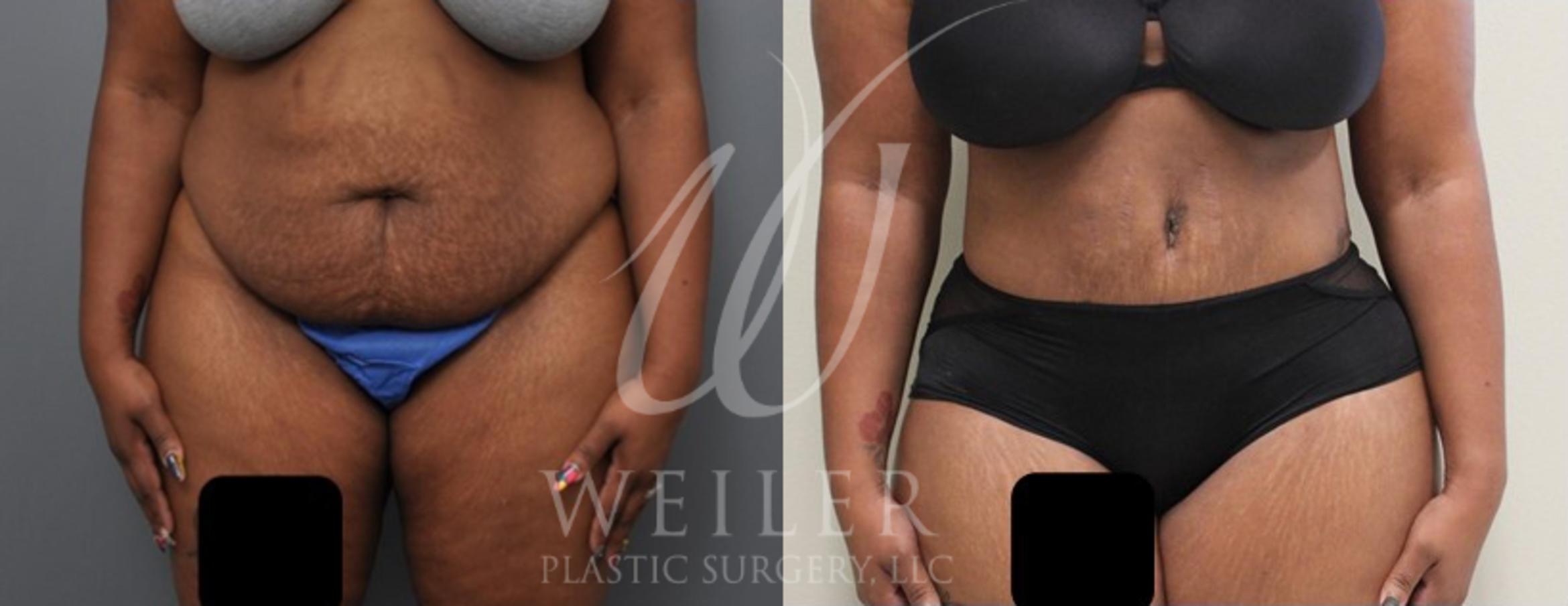 Tummy Tuck Before & After Photo | Baton Rouge, Louisiana | Weiler Plastic Surgery