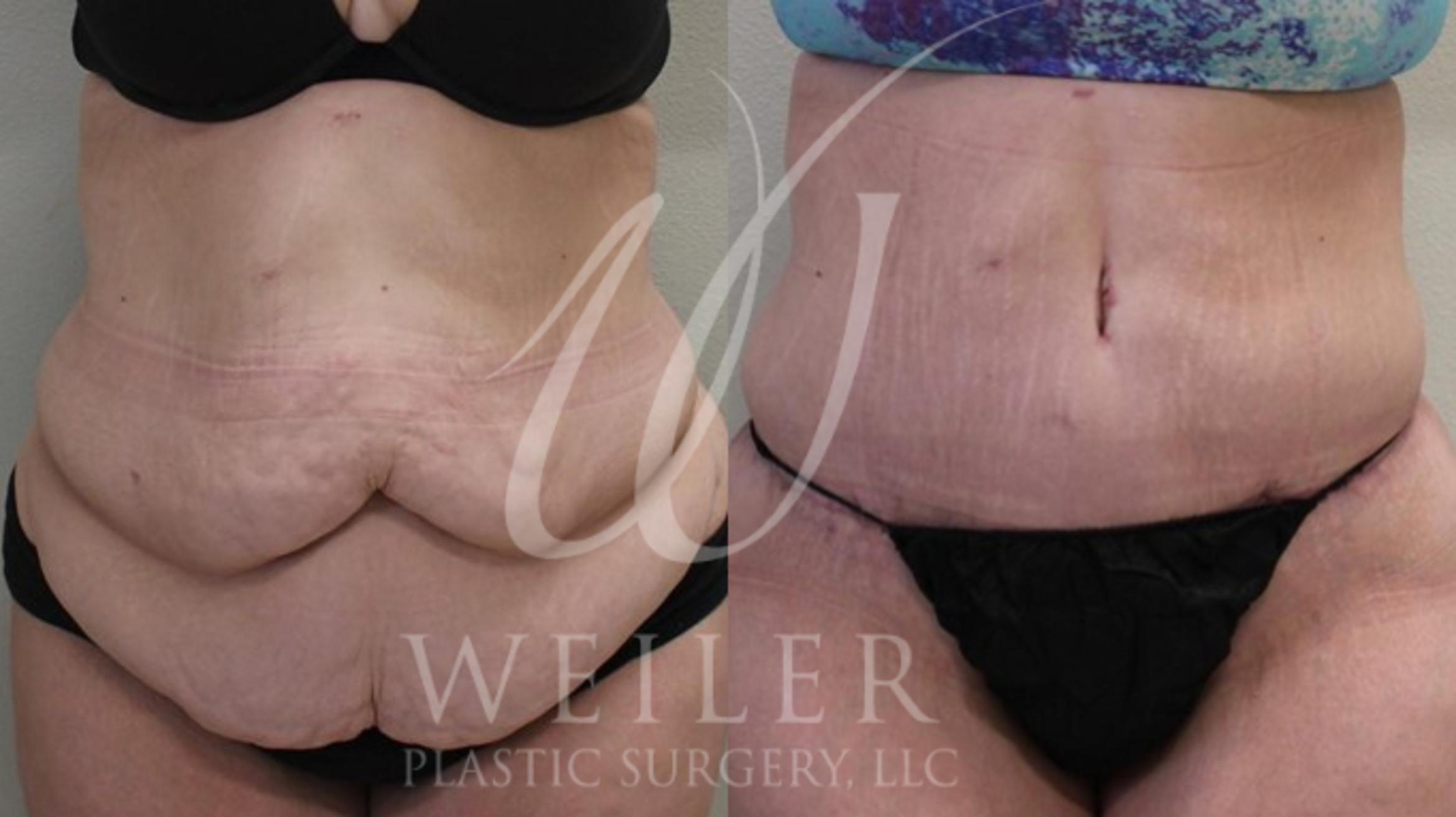 Tummy Tuck Before & After Photo | Baton Rouge, Louisiana | Weiler Plastic Surgery