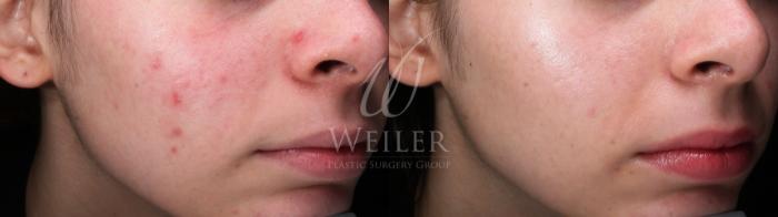 Before & After Aerolase Case 1585 Right Oblique View in Baton Rouge, New Orleans, & Lafayette, Louisiana