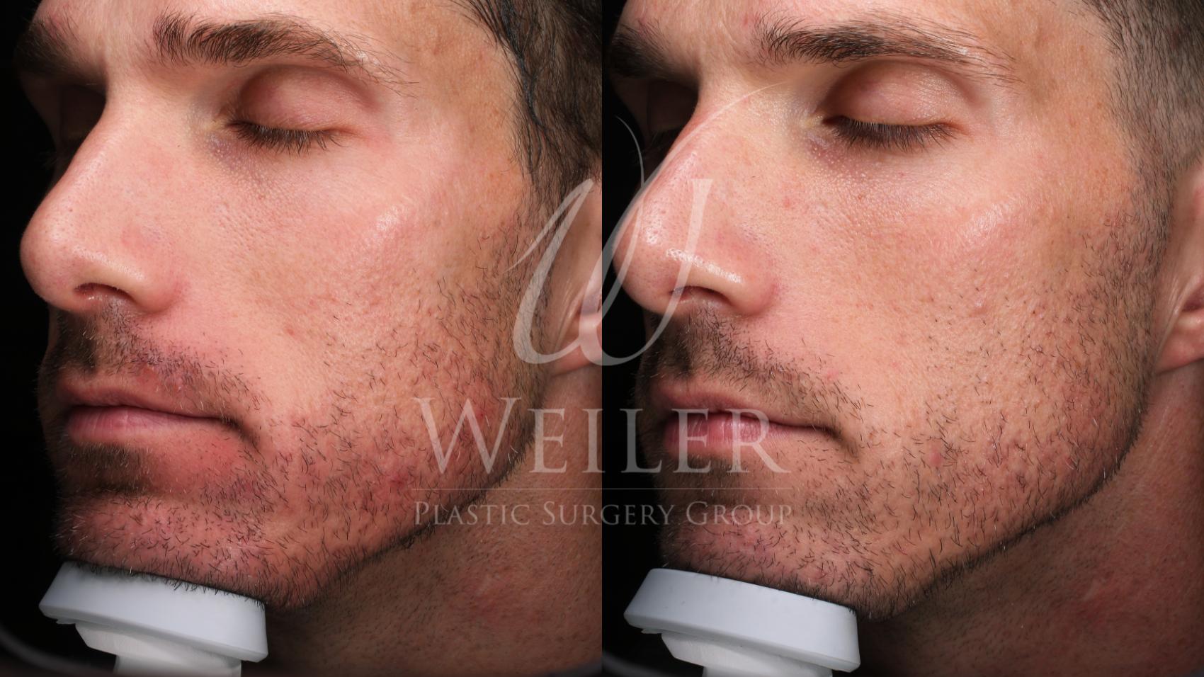 Before & After Aerolase Case 1619 Left Oblique View in Baton Rouge, New Orleans, & Lafayette, Louisiana