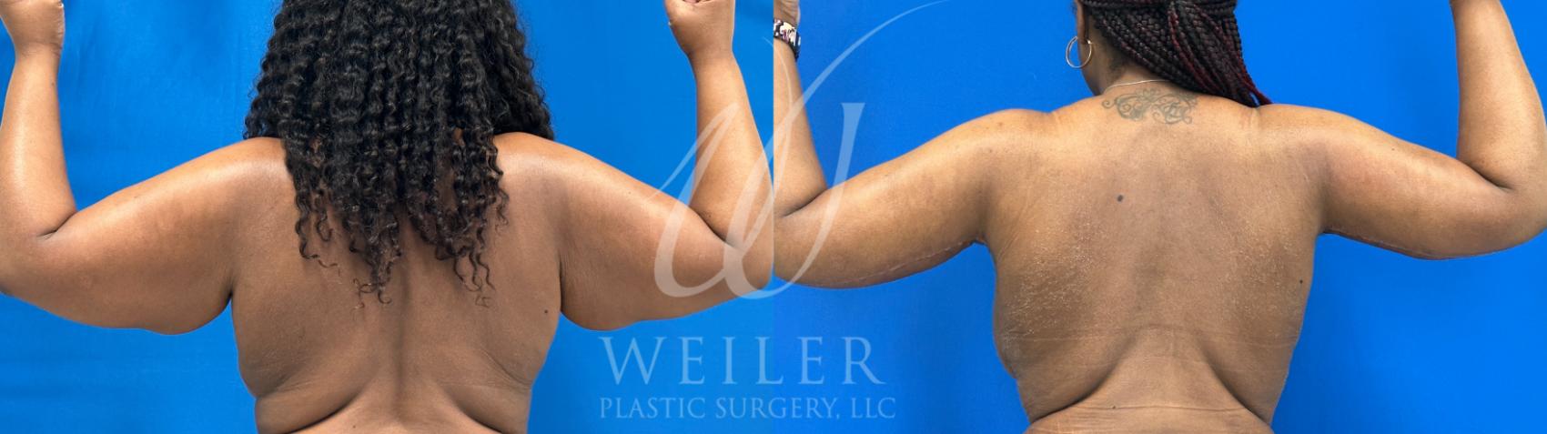 Before & After Arm Lift Case 1028 Back View in Baton Rouge, Louisiana