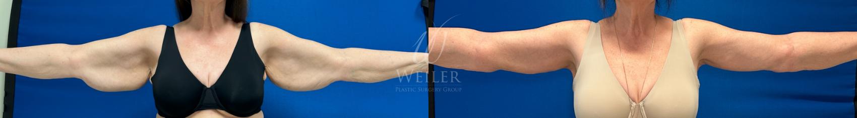 Before & After Arm Lift Case 1120 Front View in Baton Rouge, New Orleans, & Lafayette, Louisiana