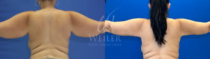 Before & After Arm Lift Case 1227 Back View in Baton Rouge, New Orleans, & Lafayette, Louisiana