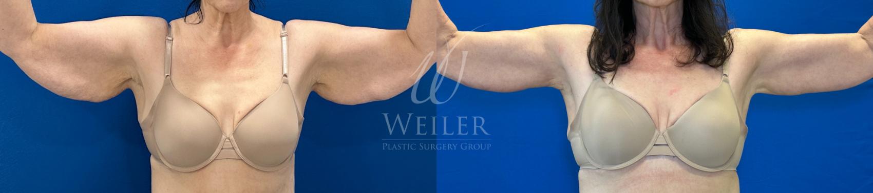 Before & After Arm Lift Case 1314 Front View in Baton Rouge, New Orleans, & Lafayette, Louisiana