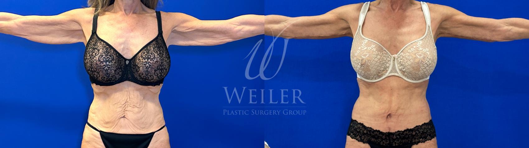 Before & After Arm Lift Case 1593 Front View in Baton Rouge, New Orleans, & Lafayette, Louisiana