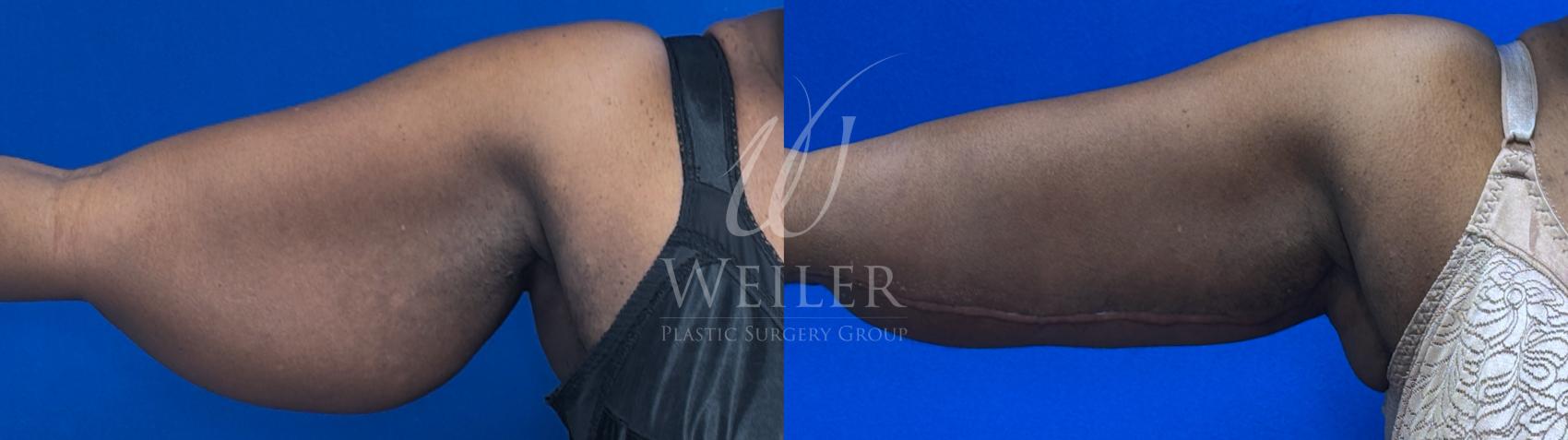 Before & After Arm Lift Case 1742 Front View in Baton Rouge, New Orleans, & Lafayette, Louisiana
