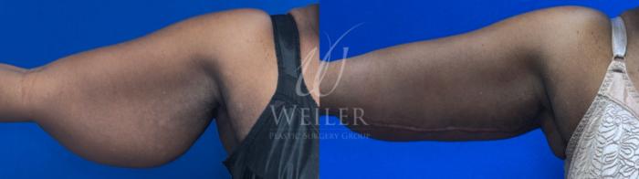Before & After Arm Lift Case 1742 Front View in Baton Rouge, New Orleans, & Lafayette, Louisiana