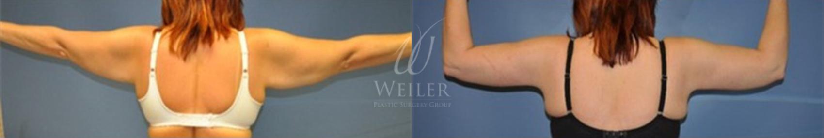 Before & After Arm Lift Case 21 View #1 View in Baton Rouge, Louisiana