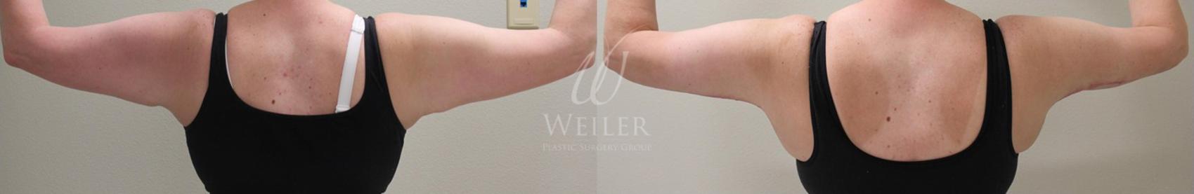Before & After Arm Lift Case 22 View #1 View in Baton Rouge, Louisiana
