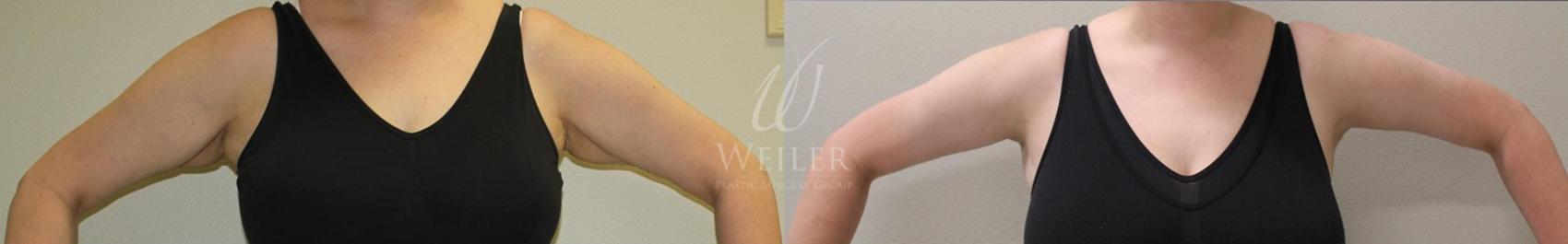 Before & After Arm Lift Case 23 View #1 View in Baton Rouge, New Orleans, & Lafayette, Louisiana
