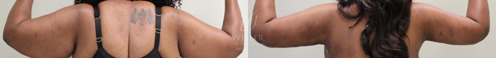 Before & After Arm Lift Case 24 View #1 View in Baton Rouge, Louisiana