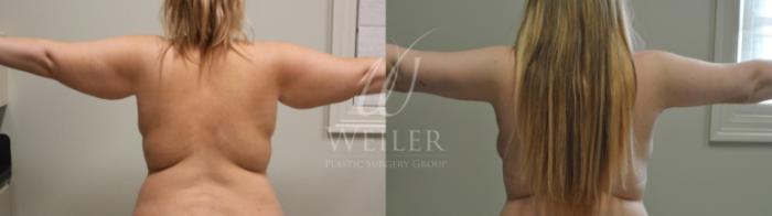 Before & After Arm Lift Case 249 View #1 View in Baton Rouge, Louisiana