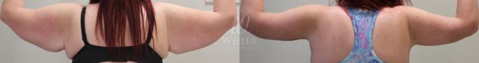Before & After Arm Lift Case 25 View #1 View in Baton Rouge, New Orleans, & Lafayette, Louisiana
