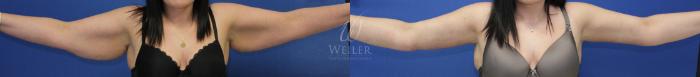 Before & After Arm Lift Case 441 View #1 View in Baton Rouge, Louisiana