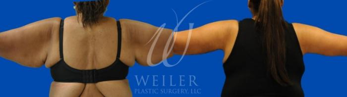 Before & After Arm Lift Case 939 Back View in Baton Rouge, Louisiana