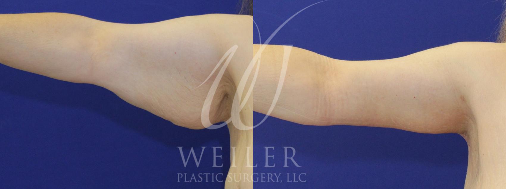 Before & After Arm Lift Case 952 Front View in Baton Rouge, New Orleans, & Lafayette, Louisiana