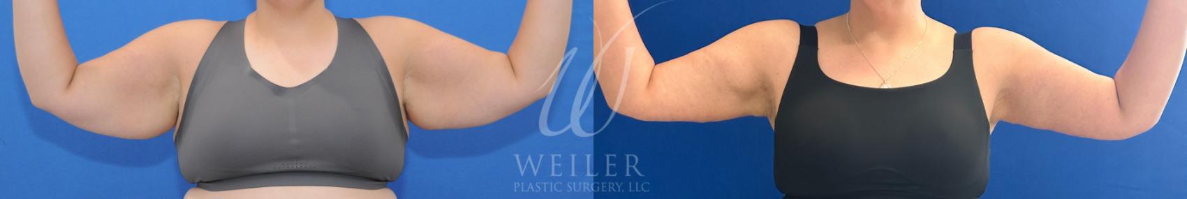 Before & After Arm Lift Case 974 Front View in Baton Rouge, Louisiana