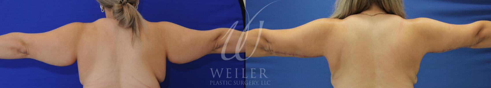 Before & After Arm Lift Case 998 Back View in Baton Rouge, New Orleans, & Lafayette, Louisiana