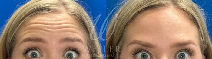 Before & After BOTOX® Cosmetic Case 1036 Front View in Baton Rouge, New Orleans, & Lafayette, Louisiana