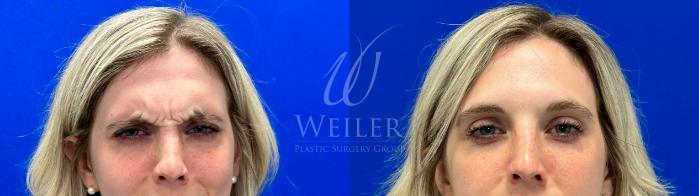 Before & After BOTOX® Cosmetic Case 1077 Front View in Baton Rouge, Louisiana