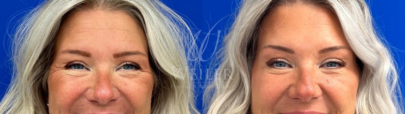 Before & After BOTOX® Cosmetic Case 1174 Front View in Baton Rouge, New Orleans, & Lafayette, Louisiana