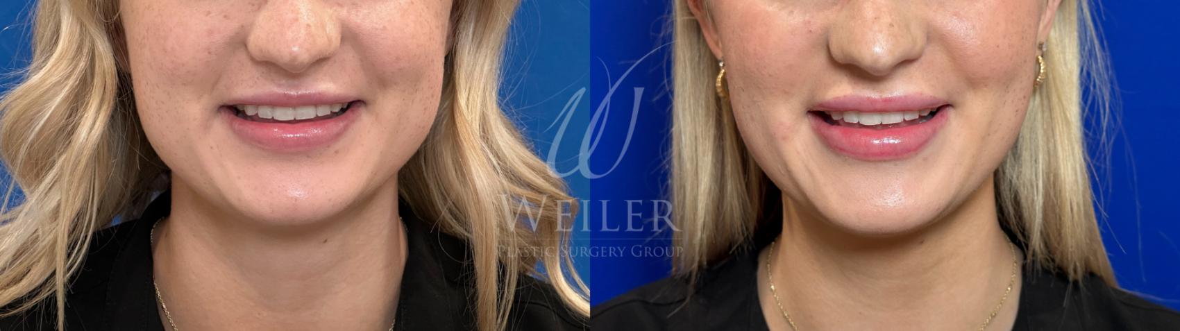 Before & After BOTOX® Cosmetic Case 1175 Front View in Baton Rouge, New Orleans, & Lafayette, Louisiana