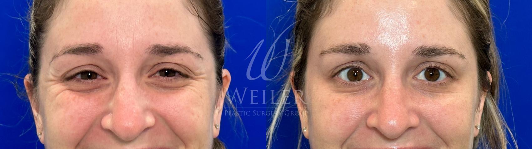 Before & After BOTOX® Cosmetic Case 1180 Front View in Baton Rouge, New Orleans, & Lafayette, Louisiana