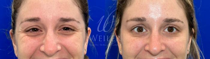 Before & After BOTOX® Cosmetic Case 1180 Front View in Baton Rouge, Louisiana