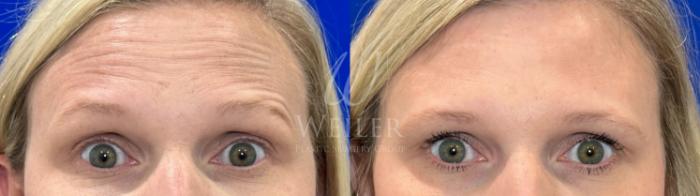 Before & After BOTOX® Cosmetic Case 1181 Front View in Baton Rouge, New Orleans, & Lafayette, Louisiana
