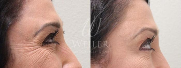 Before & After BOTOX® Cosmetic Case 12 View #1 View in Baton Rouge, New Orleans, & Lafayette, Louisiana