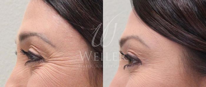 Before & After BOTOX® Cosmetic Case 12 View #2 View in Baton Rouge, New Orleans, & Lafayette, Louisiana