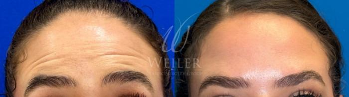 Before & After BOTOX® Cosmetic Case 1207 Front View in Baton Rouge, New Orleans, & Lafayette, Louisiana