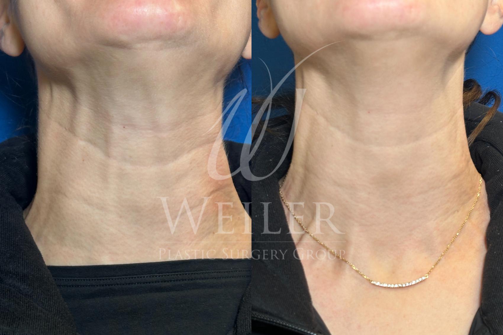 Before & After BOTOX® Cosmetic Case 1211 Front View in Baton Rouge, Louisiana