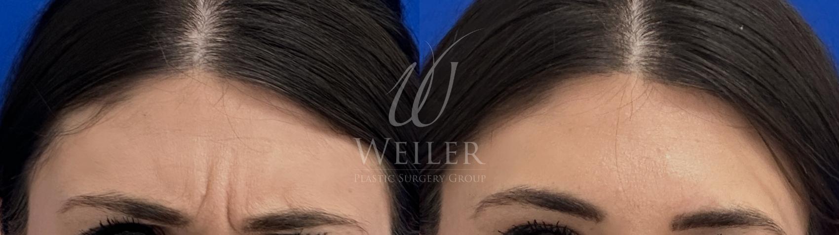 Before & After BOTOX® Cosmetic Case 1228 Front View in Baton Rouge, New Orleans, & Lafayette, Louisiana