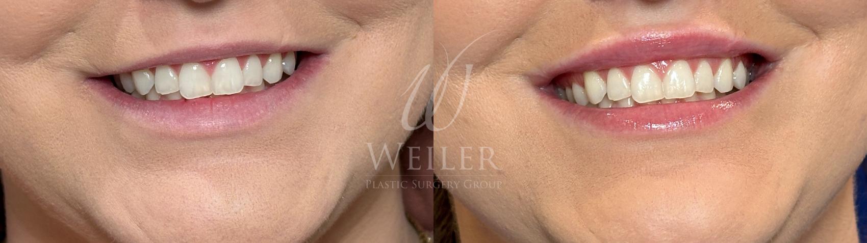 Before & After BOTOX® Cosmetic Case 1229 Front View in Baton Rouge, Louisiana