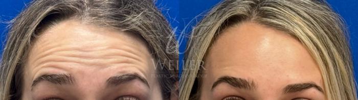 Before & After BOTOX® Cosmetic Case 1243 Front View in Baton Rouge, New Orleans, & Lafayette, Louisiana