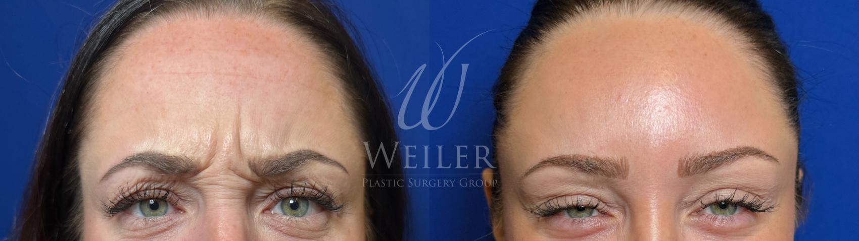 Before & After BOTOX® Cosmetic Case 1296 Front View in Baton Rouge, New Orleans, & Lafayette, Louisiana