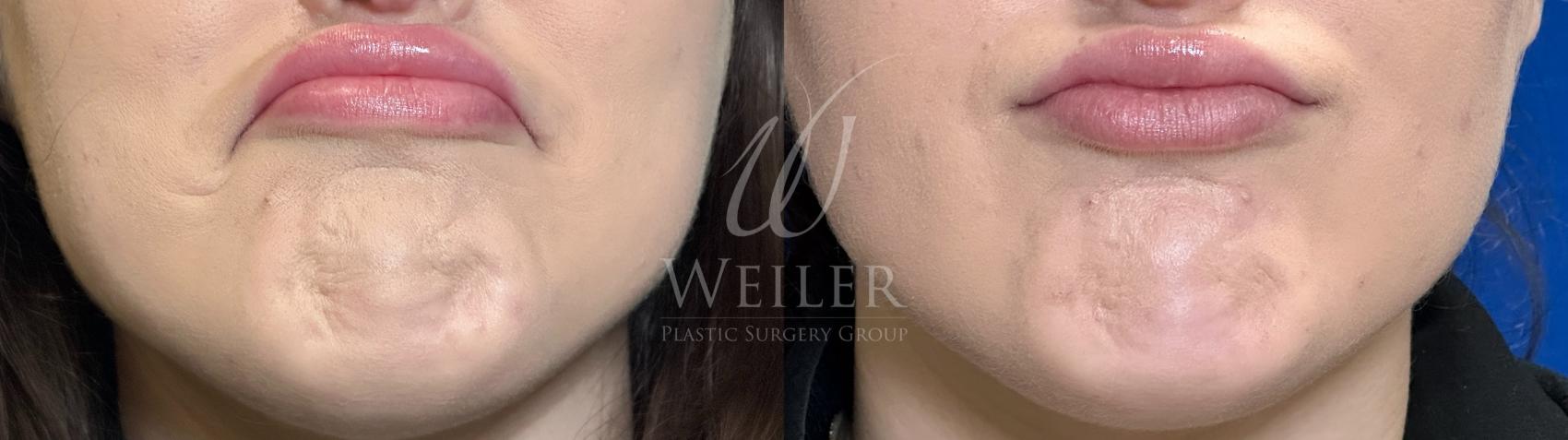 Before & After BOTOX® Cosmetic Case 1297 Front View in Baton Rouge, New Orleans, & Lafayette, Louisiana