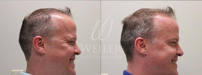 Before & After BOTOX® Cosmetic Case 13 View #2 View in Baton Rouge, New Orleans, & Lafayette, Louisiana