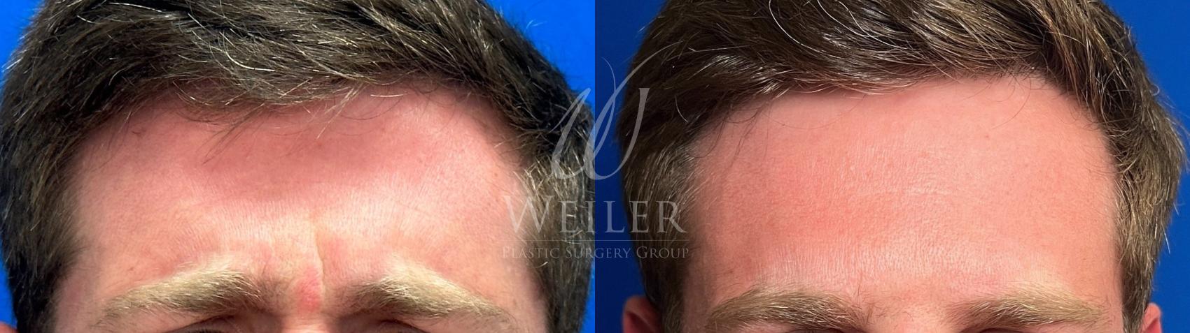 Before & After BOTOX® Cosmetic Case 1343 Front View in Baton Rouge, New Orleans, & Lafayette, Louisiana