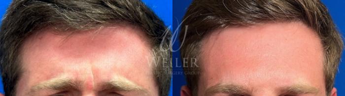 Before & After BOTOX® Cosmetic Case 1343 Front View in Baton Rouge, New Orleans, & Lafayette, Louisiana