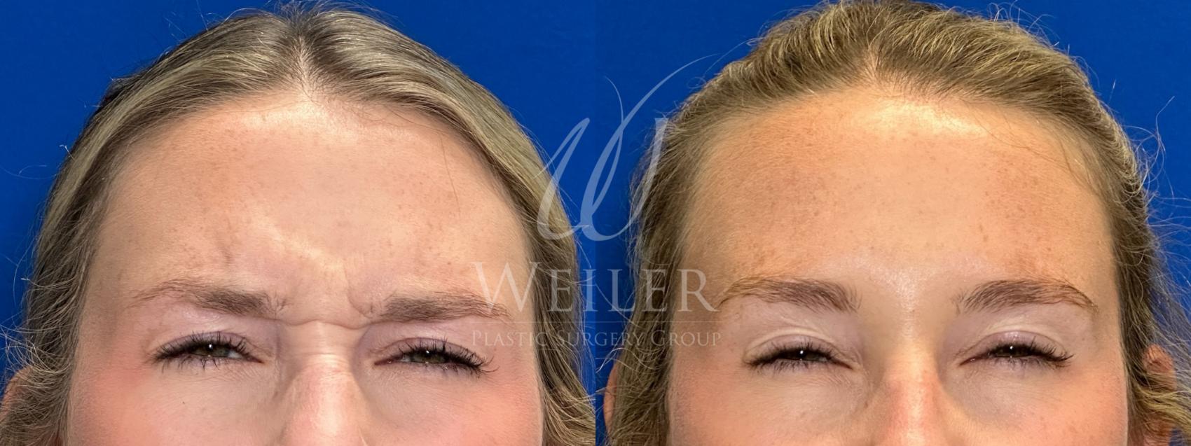 Before & After BOTOX® Cosmetic Case 1370 Front View in Baton Rouge, New Orleans, & Lafayette, Louisiana